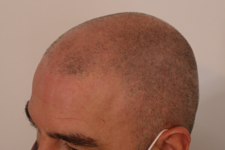 Full Head Scalp Micropigmentation Before