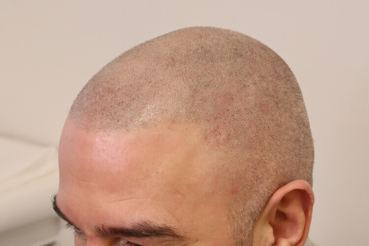 Full Head Scalp Micropigmentation After