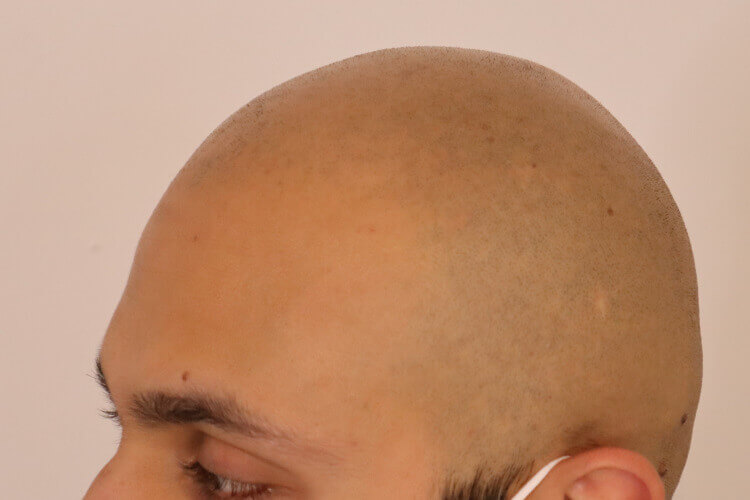 Full Head Scalp Micropigmentation