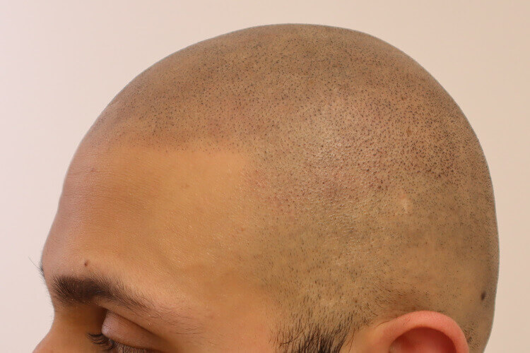 Full Head Scalp Micropigmentation
