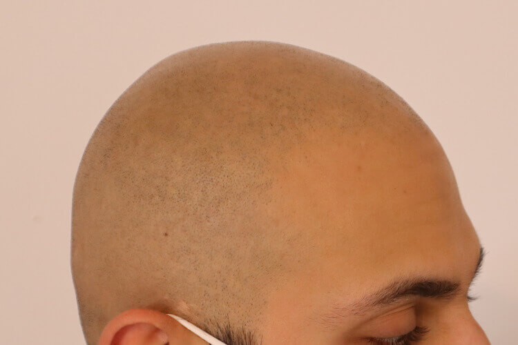 Full Head Scalp Micropigmentation Before