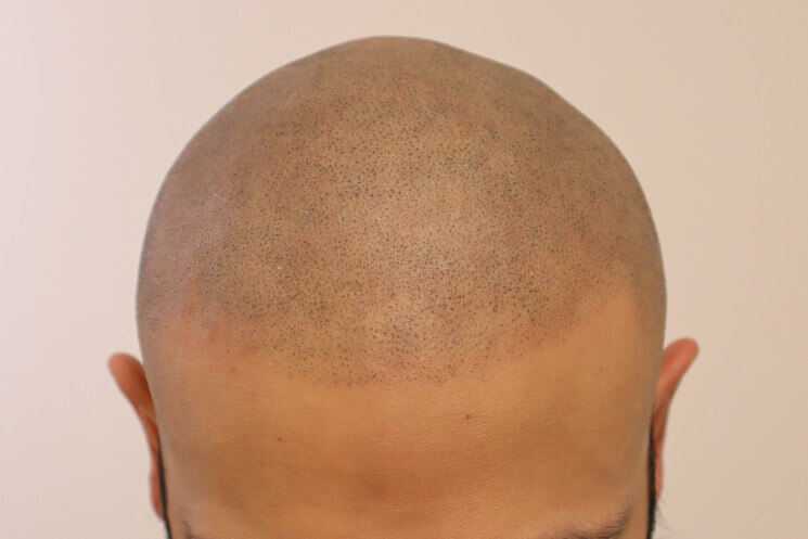 Full Head Scalp Micropigmentation After
