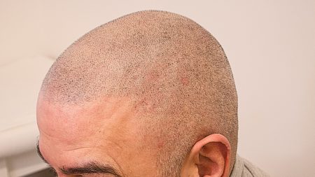 Geoffrey Villenas on Instagram HAIR TATTOO  BALD with MASSIVE HEAD  INJURIES AND MULITPLE HAIR TRANSPLANTS  Scalpmicropigmentation was the  only thing that helped