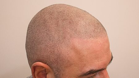 Worst Hair Tattoo Ever  Do Due Diligence for Scalp Micropigmentation   YouTube