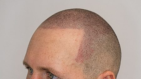 Full Head Scalp Micropigmentaion 