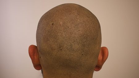 Crown Scalp Micropigmentation
