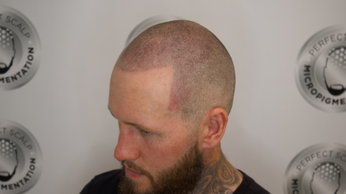 Scalp Micropigmentation, what is it