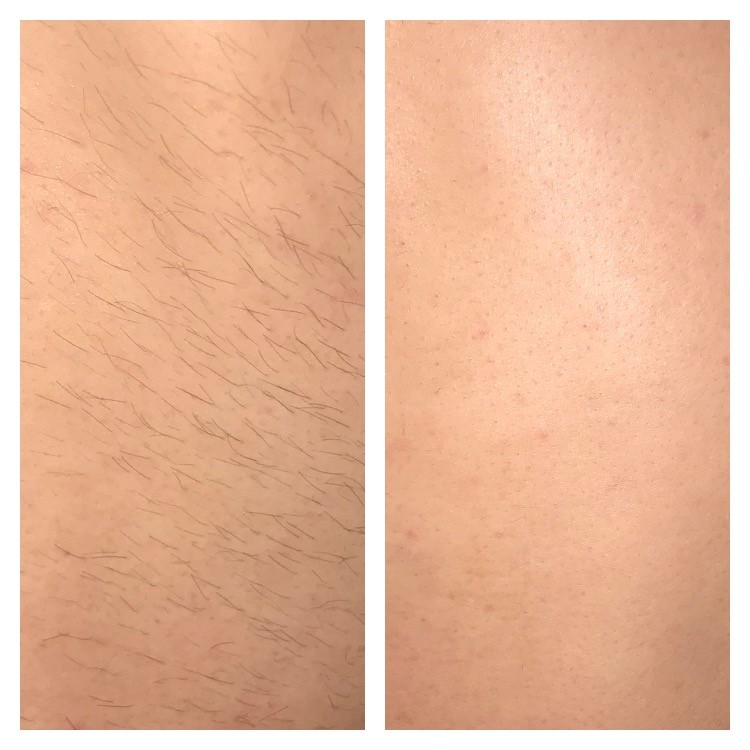 Male Hair Removal By Laser