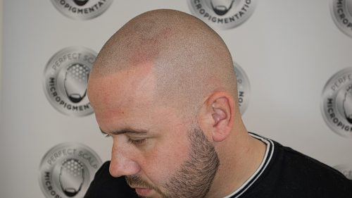 What is Scalp Micropigmentation Manchester
