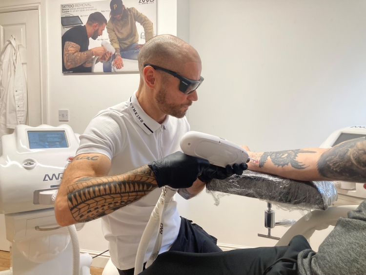 Tattoo Removal By Laser