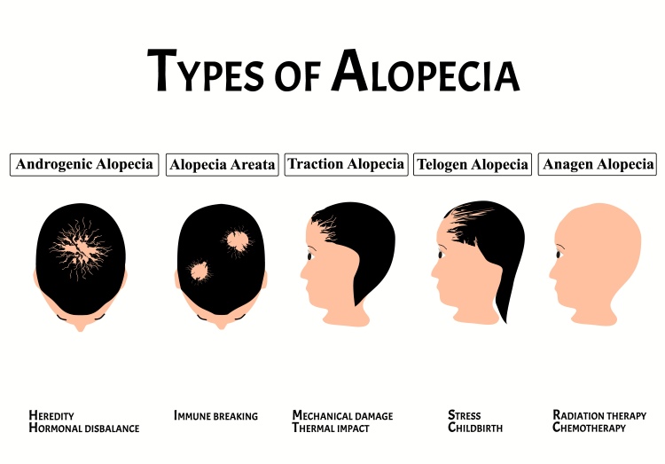 Scalp Micropigmentation for Alopecia
